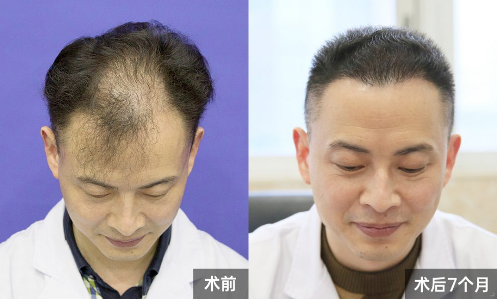 我院醫護人員植髮成功案例|微針植髮修復髮際線+頭頂加密,7個月逆襲精神面貌