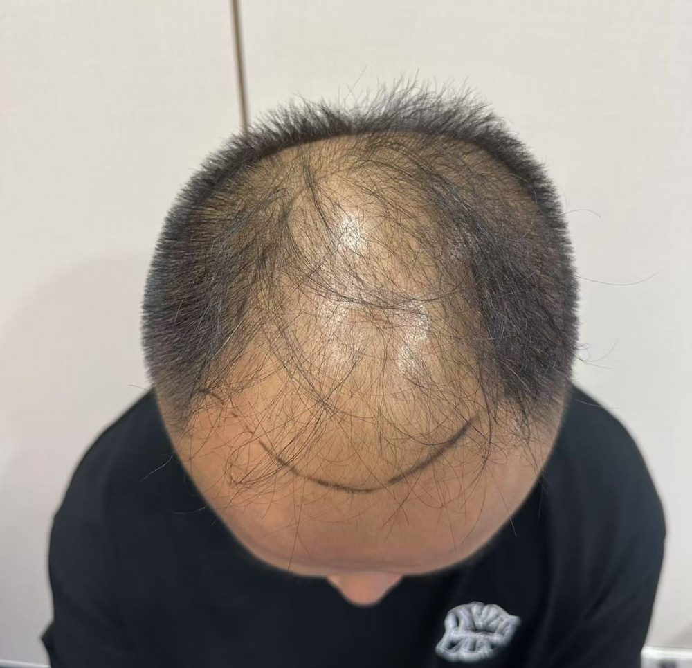 頭頂「地中海」點形成?雄激素性脫髮成因+香港應對策略
