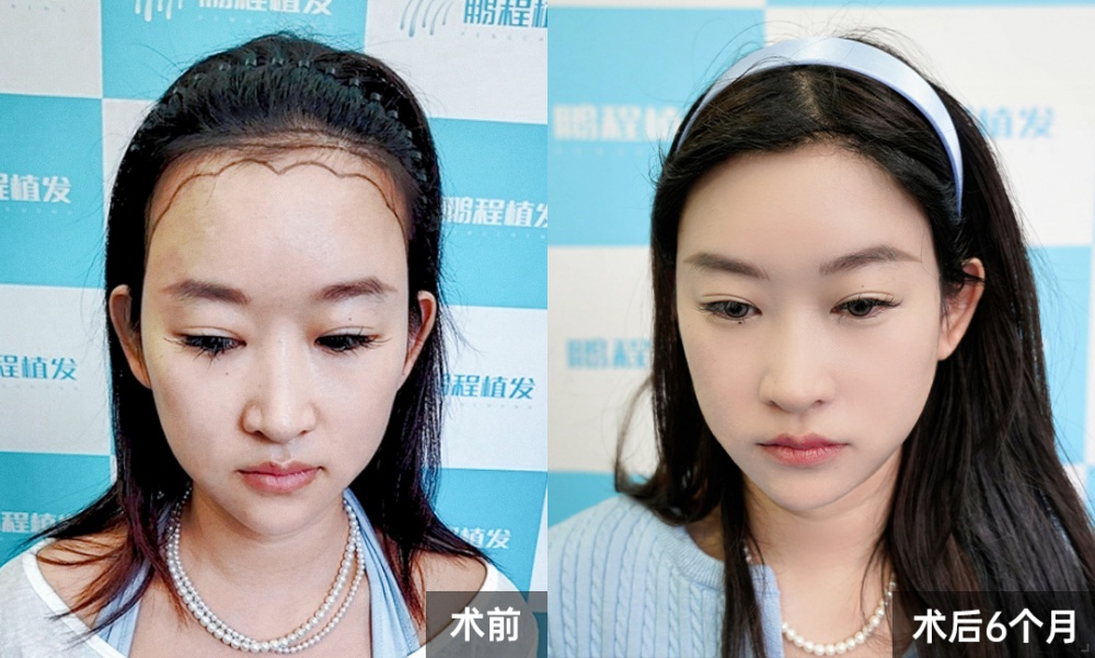 術後半年·原生感髮際線完美成型 術後半年·原生感髮際線完美成型
