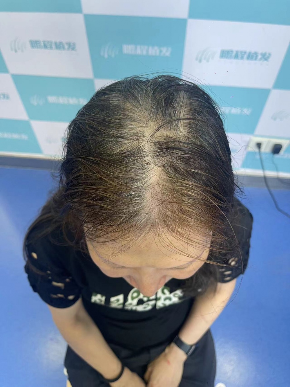 髪縫稀疏 髪縫稀疏