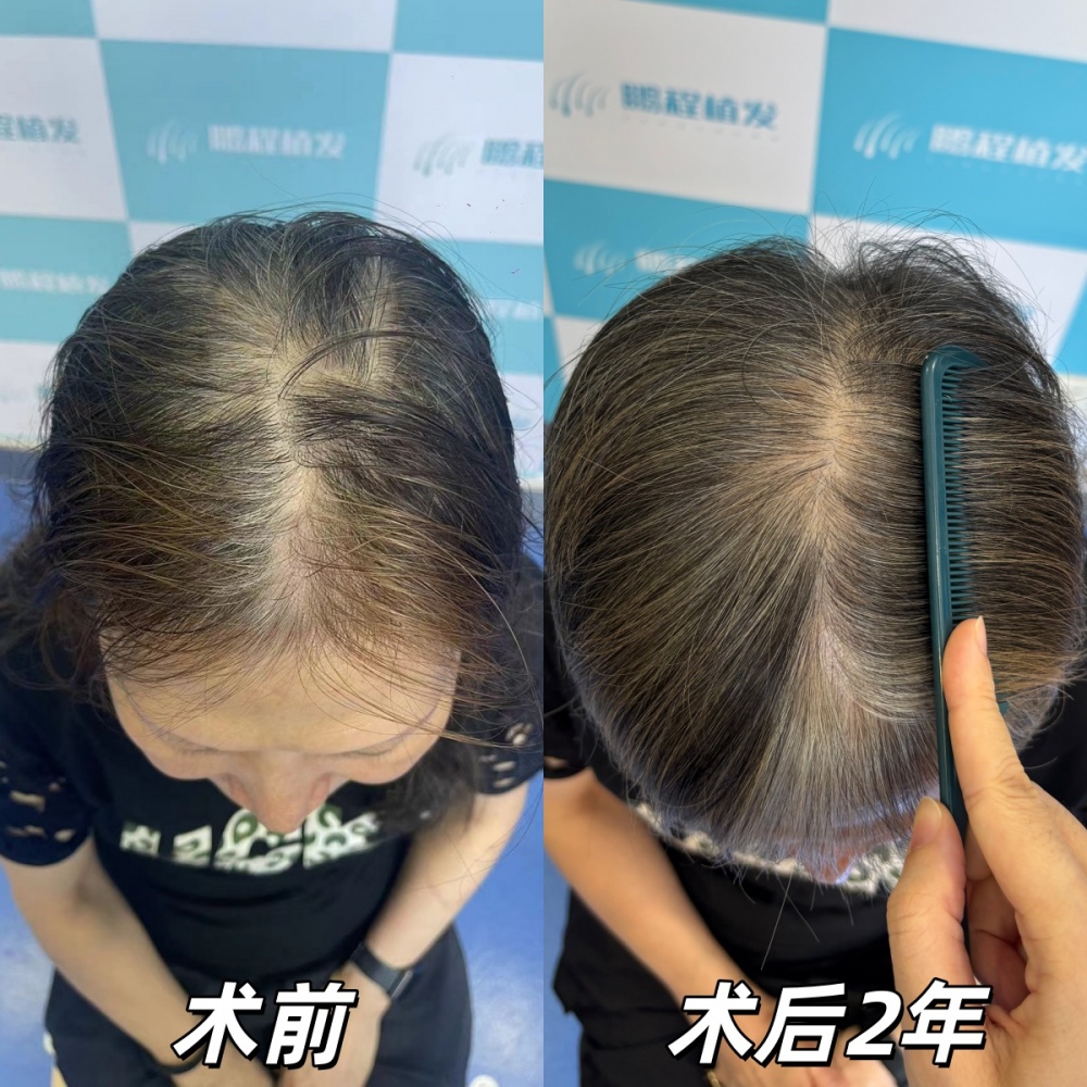 術後即刻到術後2年 術後即刻到術後2年