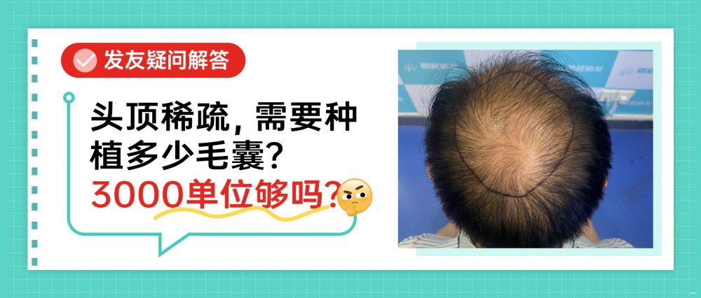 香港植髮|頭頂稀疏植幾多毛囊?3000 毛囊單位足唔足夠