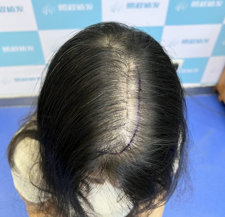 女性脫髪用5%米諾地爾得唔得？深圳植髪醫生解答濃度迷思，附安全用法