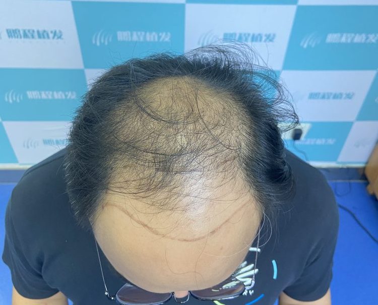 香港頭頂稀疏點算好?加密植髮前必知問題+費用參考
