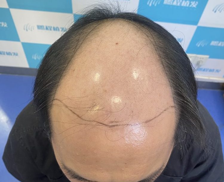 😱 後枕毛囊唔夠？大面積脫髮植髮仲有冇計｜鵬程植髮医生畀你5個實戰方案！