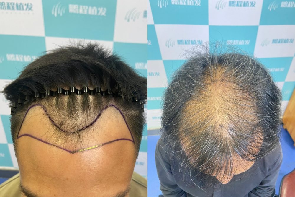 🧑🦱 男士M禿+頭頂稀疏 脫髮到幾級才可以植髮?|植髮黃金期指南
