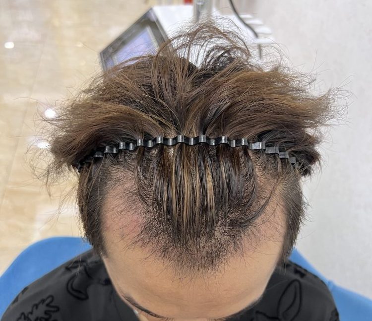植髮後脫落期好驚慌?30日毛囊炎護理手冊 | 香港髪友必讀